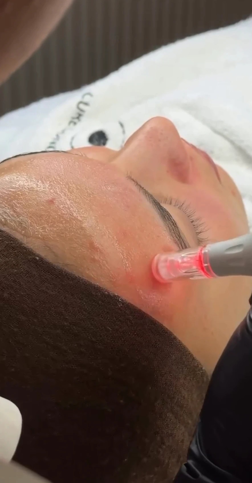Microneedling im Detail